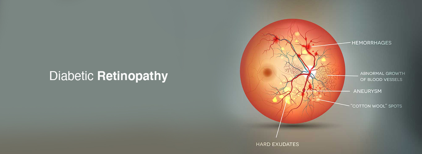 Diabetic Retinopathy – The leading cause of Blindness.